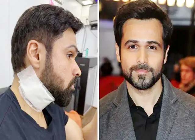 शूटिंग के दौरान घायल हुए इमरान हाशमी, फोटो वायरल